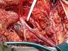 graft vascularization is crucial in Total Phalloplasty