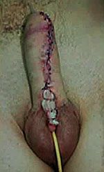 urethroplasty completed