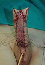 urethroplasty graft removal