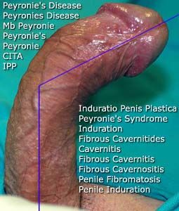 Peyronie's Disease, IPP, Induratio Penis Plastica, Mb Peyronie, Peyronie