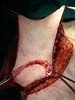 removed MLD graft for Total Phalloplasty
