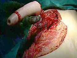 tubularized neophallus