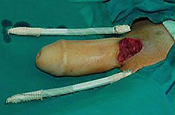Total Phalloplasty Stage Three: penile prosthesis implantation