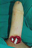 Stage Three: penile implant