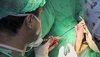 Perovic Total Phalloplasty Stage Two surgery
