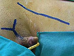 FtM SRS Gender Reassignment Surgery: Metoidioplasty to Total Phallplasty