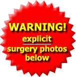 Warning! Explicit graphic surgical photos below!