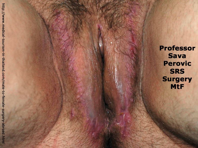 Male Vagina Surgery