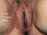 Male to female surgery vaginoplasty before and after photos