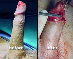 Penis enlargement surgery requires good skin elasticity
