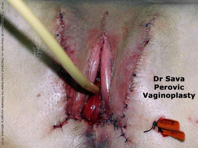 Penis Into Vagina Surgery 118