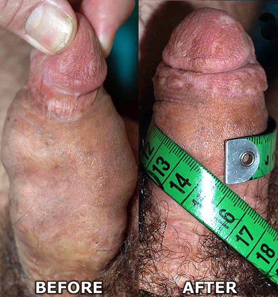 Penis Surgery Before After 64