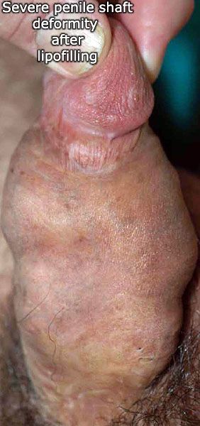 Permanent Enlarged Penis 3