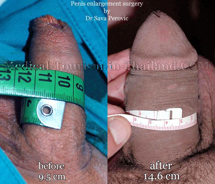 Penis Enlargement Surgery Results 3