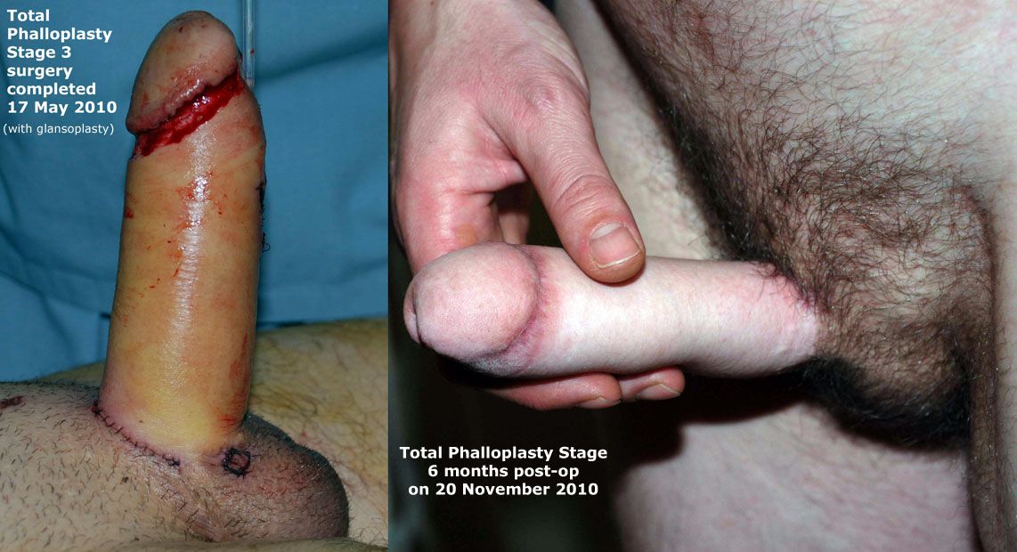 Perovic Total Phalloplasty.