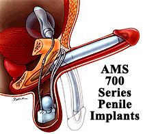 AMS penile implants can be safely inserted into Perovic Total Phalloplasty patients
