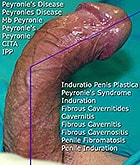 Peyronie's Disease, IPP, Induratio Penis Plastica, Mb Peyronie, Peyronie