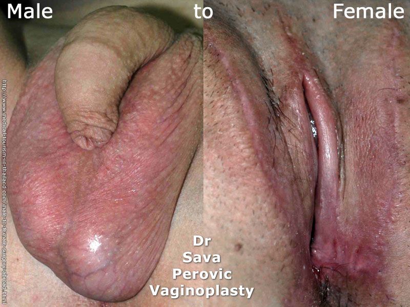 Male To Female Vagina Afterward