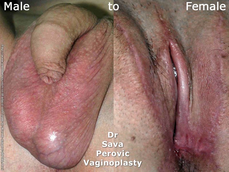 Tgirl Transformation Penis To Vagina