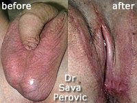 Male to female surgery vaginoplasty before and after photos