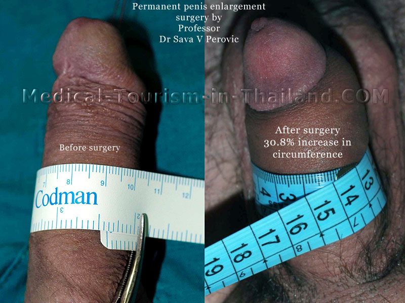 Cock Enlargements 11