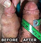 photo: Penis enlargement pics - penis enlargement before and after
