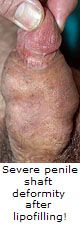 Severe penile shaft deformity after lipofilling but before Sava Perovic penis enlargement surgery