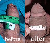 photo: Surgical penis enlargement by Sava Perovic Foundation