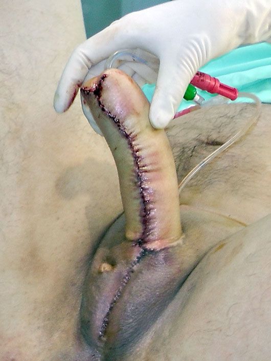 Post operation penis